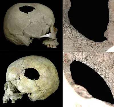 HCA Cambridge World History of Violence Perimortem blunt force injuries on skulls from the Late Jomon sit